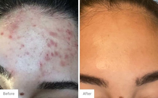 Acne Real Results Image 4